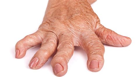 Artrit ve artrit tedavi edilebilir mi?